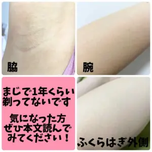 脱毛器はいつ剃る？剃ったあとの効果的な使い方