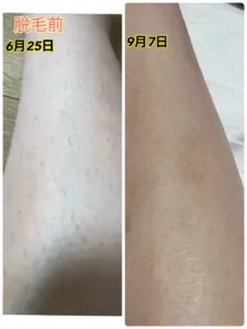 脱毛器を使ったあと、毛の処理はどうする？