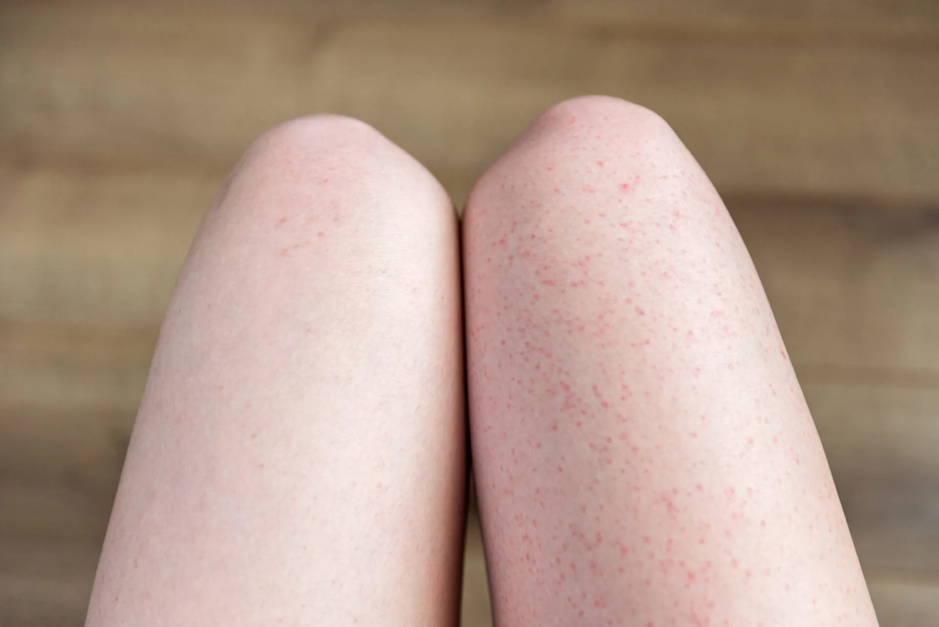 脱毛器は剃ったあとすぐ使っていい？効果が変わる正しい毛の処理タイミングとはアイキャッチ
